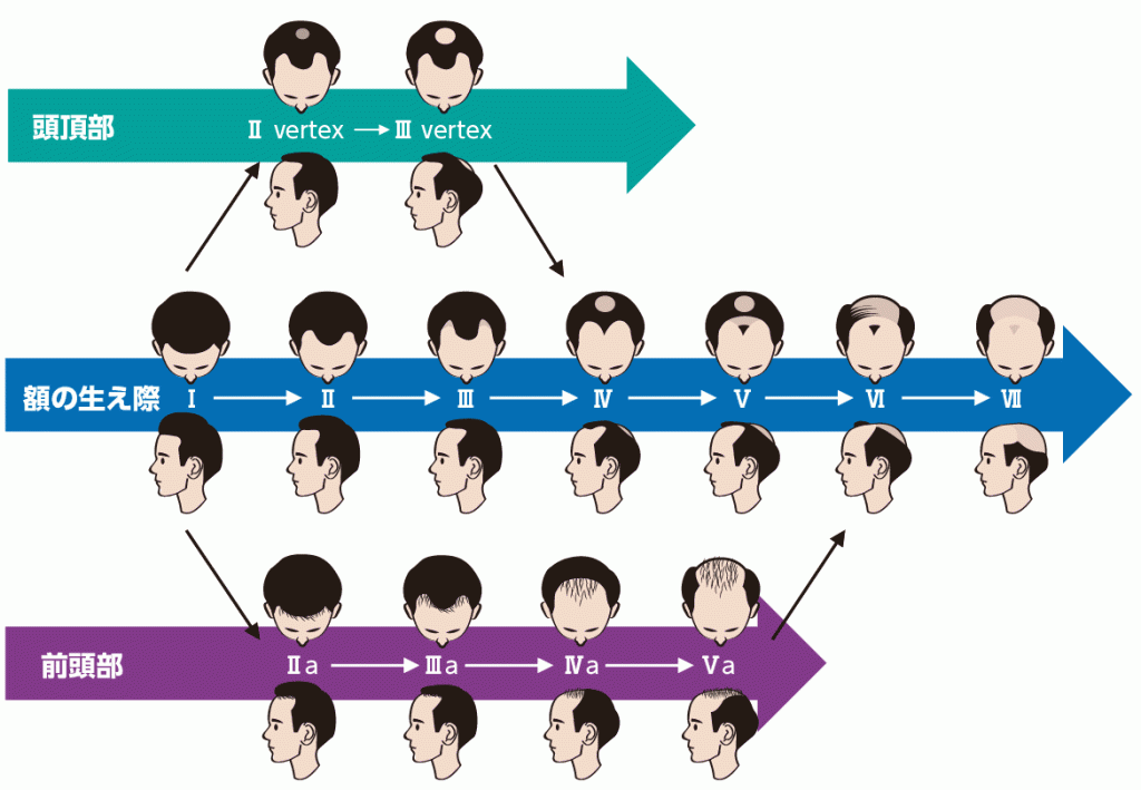 禿の進行順