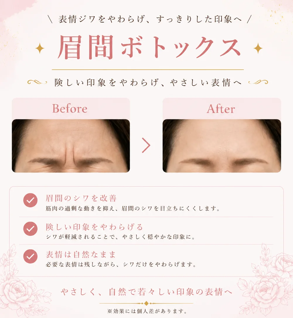 ボツリヌストキシン注射の症例写真(眉間のしわ)|ヒロクリニック美容皮膚科