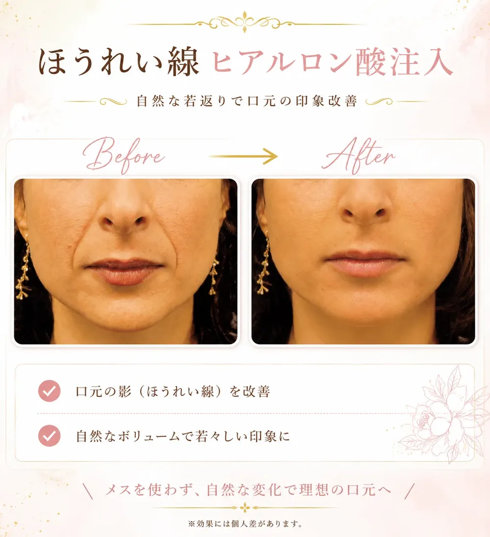ヒアルロン酸注入の症例写真(ほうれい線)|ヒロクリニック美容皮膚科