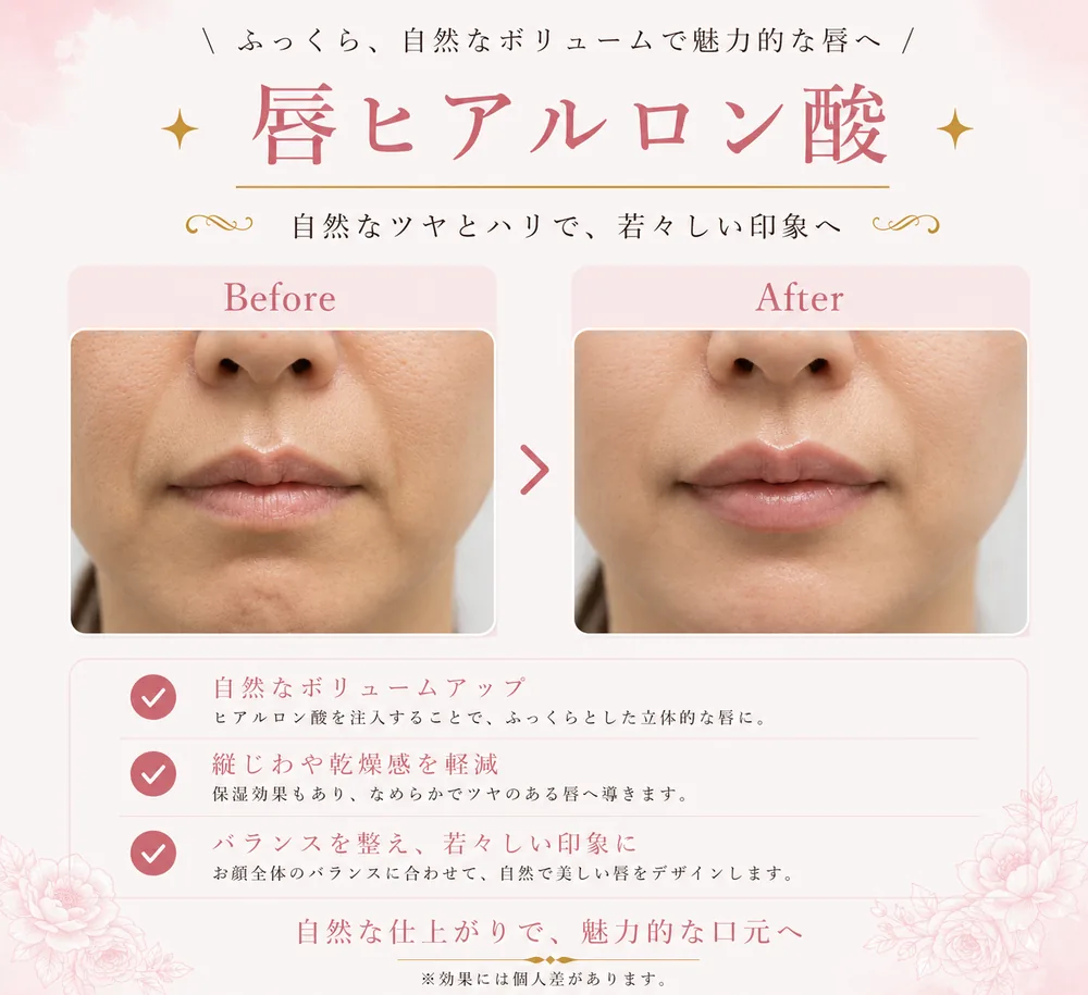 ヒアルロン酸注入の症例写真(唇(0.2〜0.4cc使用))|ヒロクリニック美容皮膚科