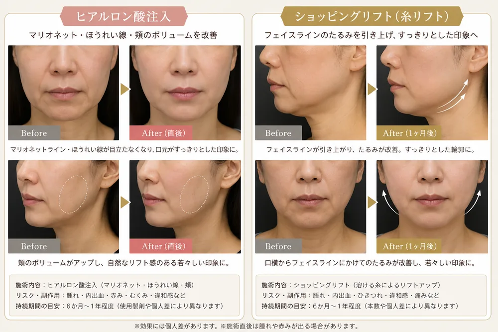 ヒアルロン酸注入の症例写真(マリオネット・ほうれい線・頬(1か月後))|ヒロクリニック美容皮膚科