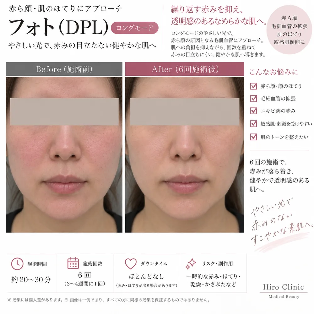 フォトRF(DPL光治療)の症例写真(赤ら顔・ほてり(6回施術後))|ヒロクリニック美容皮膚科