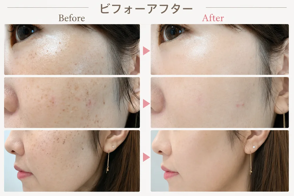 フォトRF(IPL光治療)の症例写真(しみ・肌あれ)|ヒロクリニック美容皮膚科