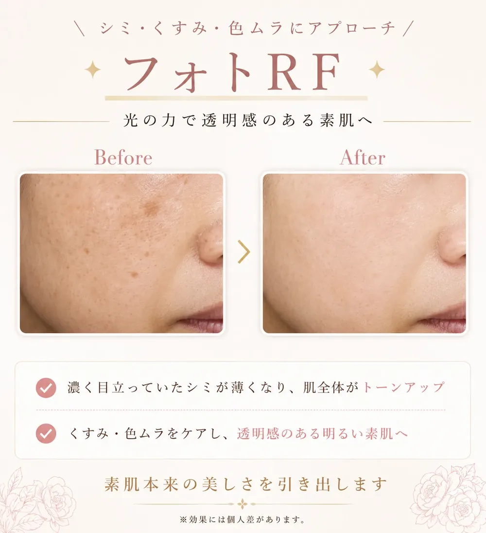 フォトRF(IPL光治療)の症例写真(肌のトーン)|ヒロクリニック美容皮膚科