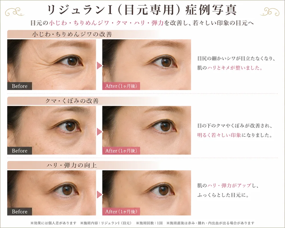 リジュランIの症例写真(目元の小じわ(1回・1か月後))|ヒロクリニック美容皮膚科
