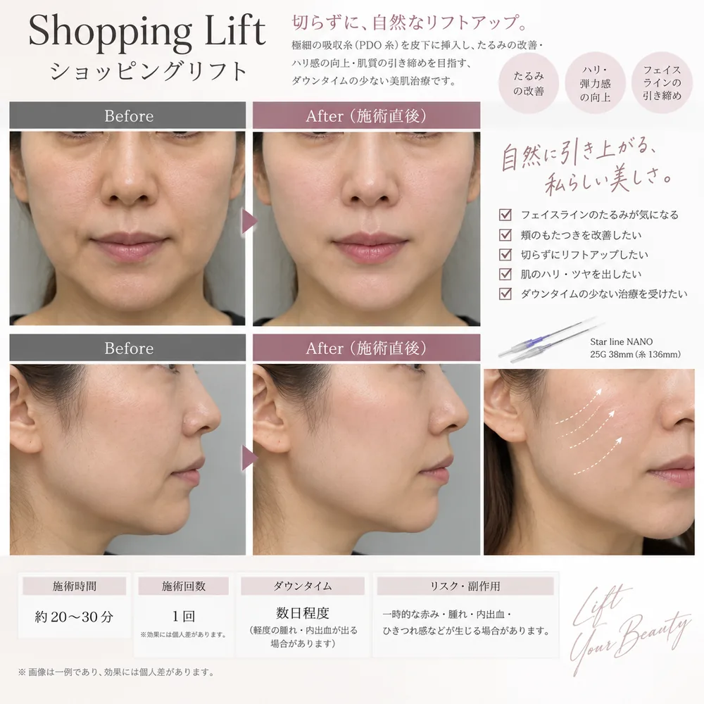 ショッピングスレッド(10本)の症例写真(たるみ(施術直後))|ヒロクリニック美容皮膚科