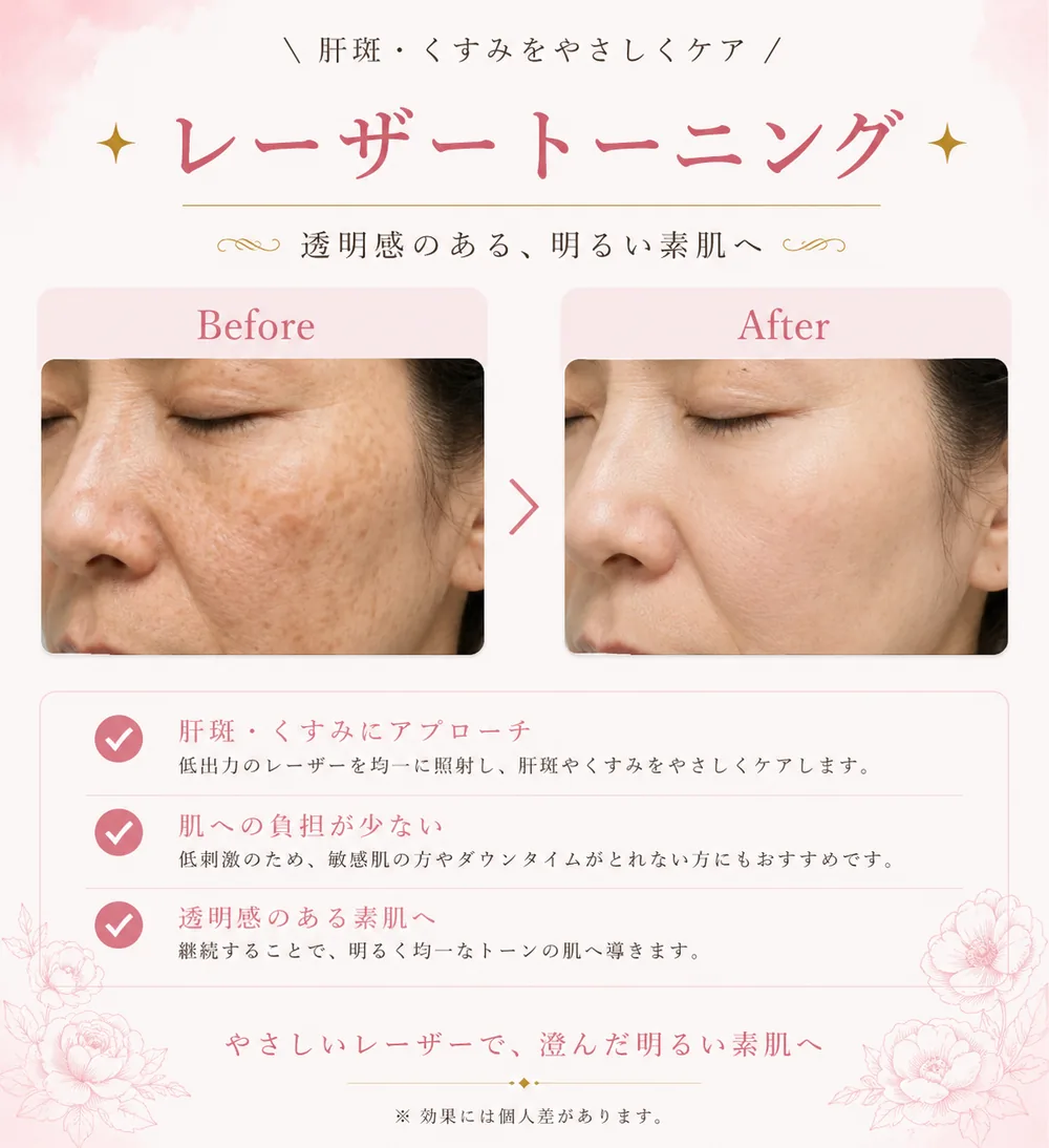 レーザートーニングの症例写真(肝斑・くすみ)|ヒロクリニック美容皮膚科