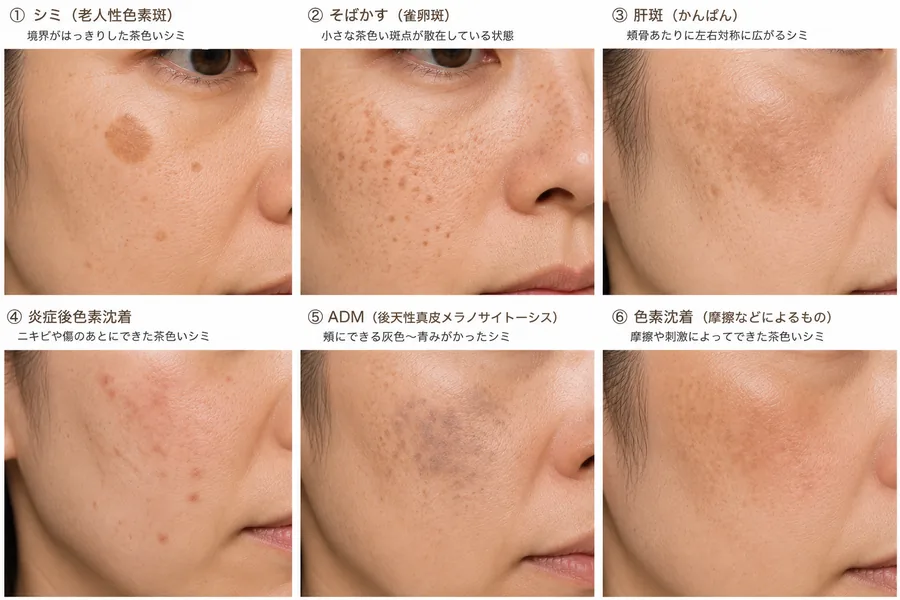 しみ(複数の種類)の見本画像|ヒロクリニック美容皮膚科