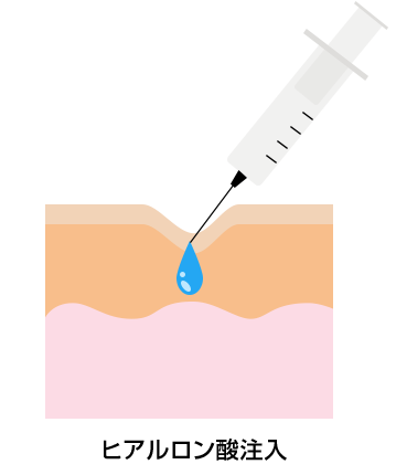ヒアルロン酸注入