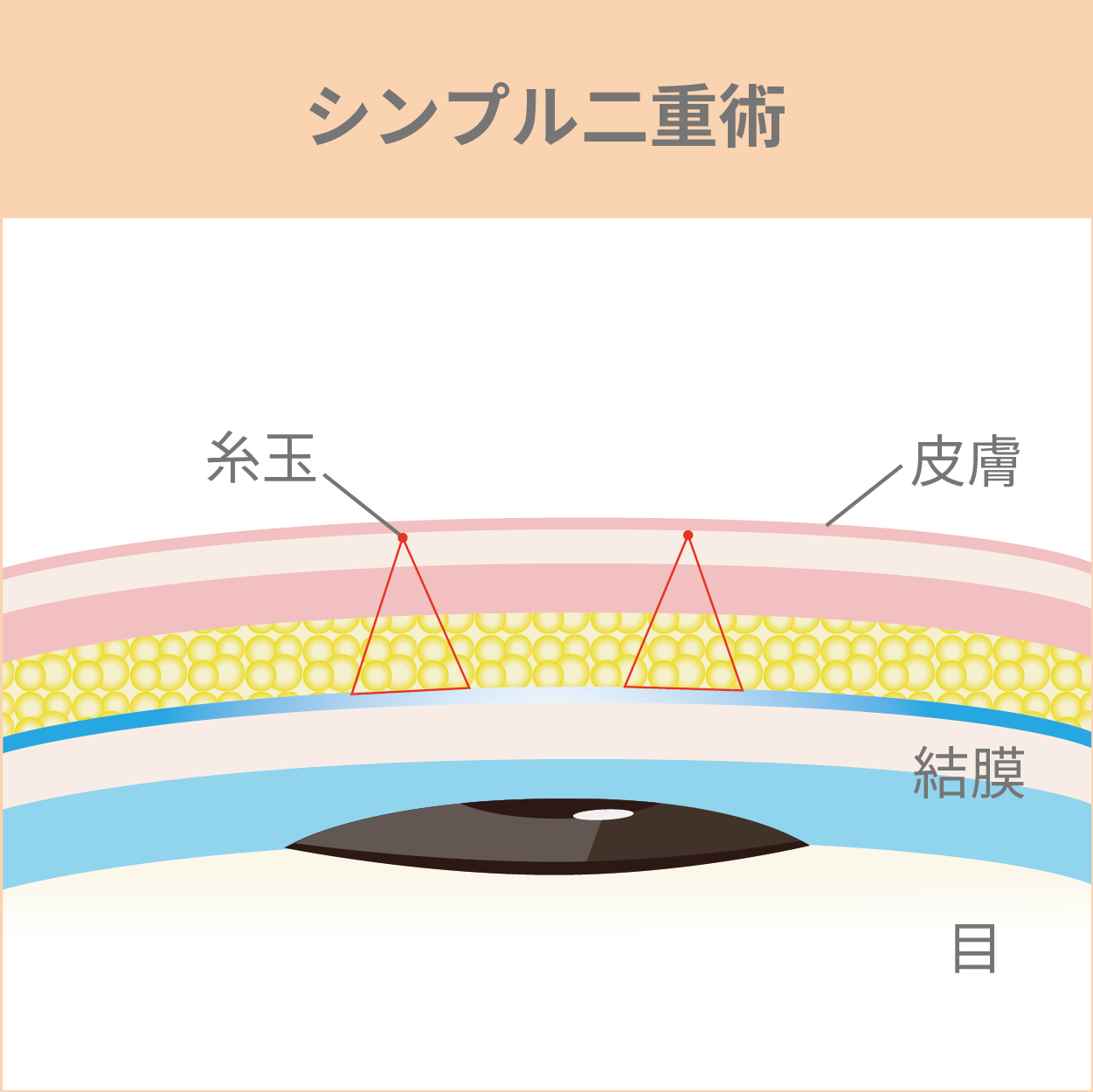 シンプル二重術