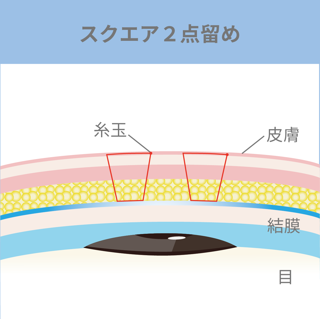 スクエア２点留め