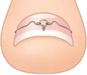 VHO式矯正法 図解