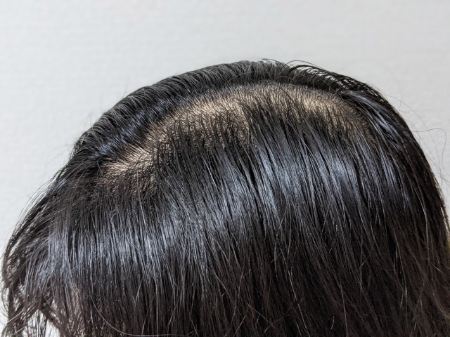 頭頂部の薄毛が進行し、ピンク色の地肌が黒髪に囲まれてはっきりと目立っている男性の頭部。男性型脱毛症(AGA)特有の頭頂部脱毛の進行例を示すイメージ。