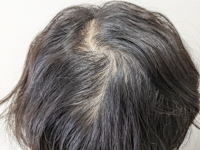 頭髪全体にわたり明らかに薄毛が進行し、頭皮が透けて見える状態の頭部。脱毛症による毛髪量の減少が一目で分かる様子。