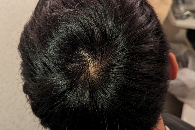 頭頂部を真上から撮影したスカルプの写真。頭皮全体が漆黒の髪でしっかり覆われており、健康的で高密度なドナーヘアの理想的な状態を示す参考イメージ