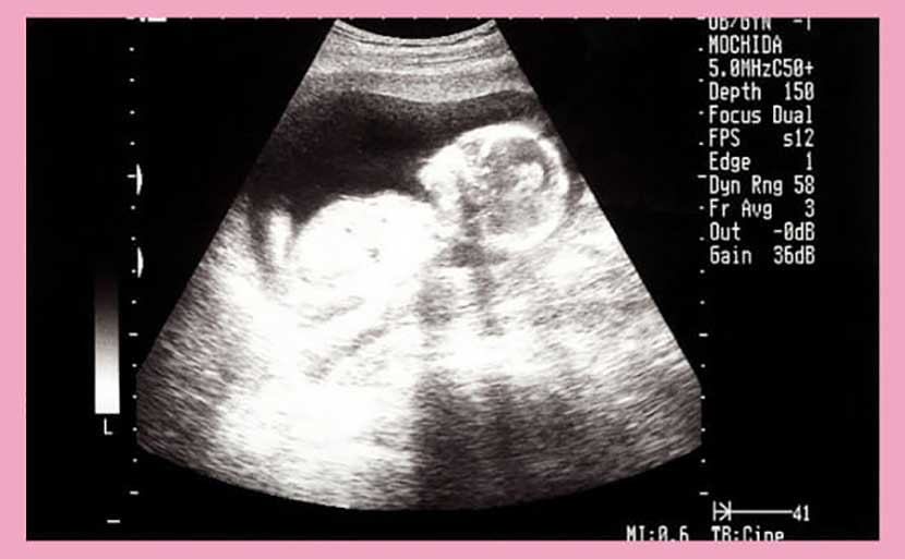 妊娠15周时的母体变化和超声照片所见的唐氏综合症 医生监修 有照片 Hiro Clinic Lang Chinese