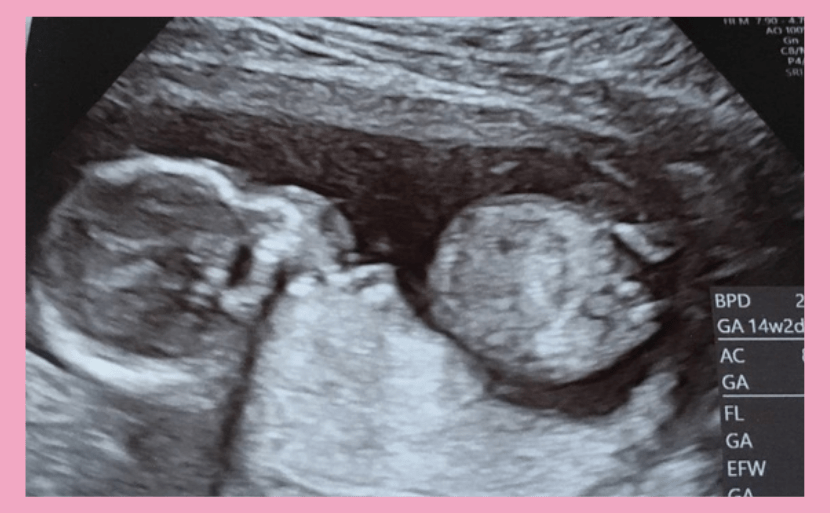 妊娠14週目にできること 医師監修 エコー写真の画像あり ヒロクリニック