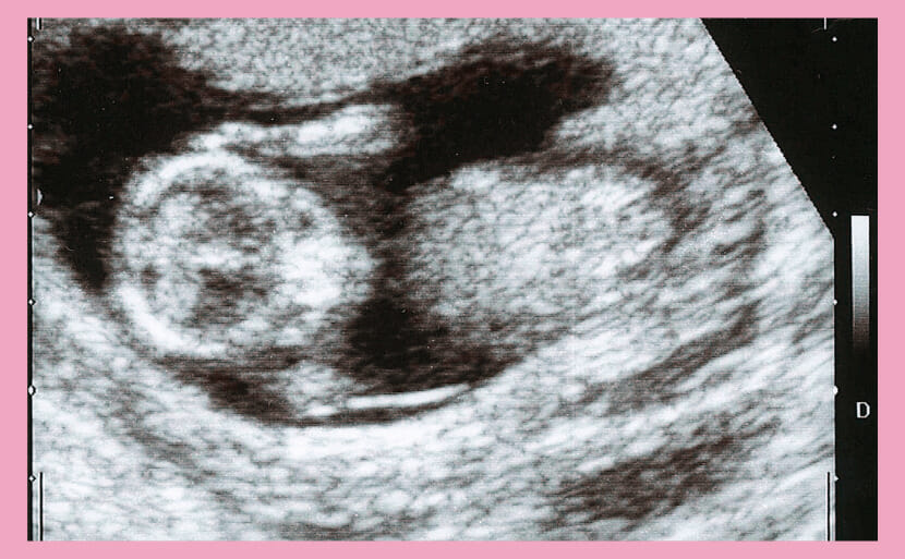 妊娠13週目にできること 医師監修 エコー写真の画像あり ヒロクリニック