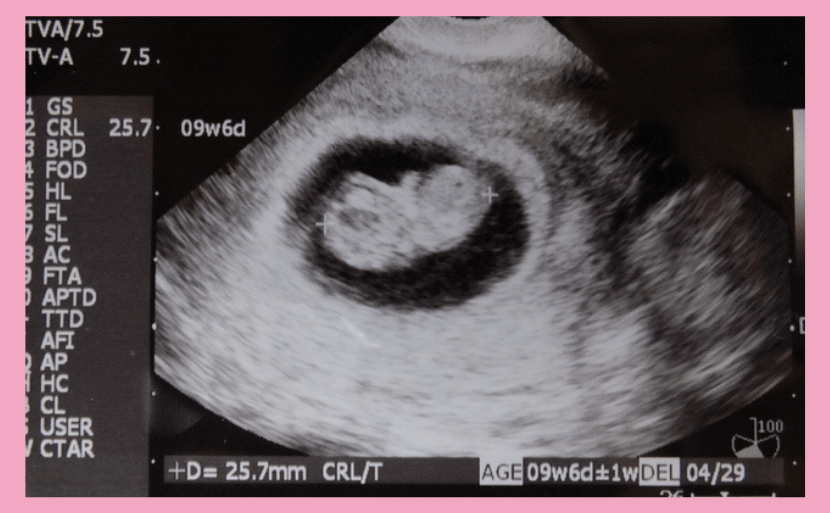 妊娠9週目の母体変化とエコーでわかるダウン症 医師監修 エコー写真の画像あり ヒロクリニック