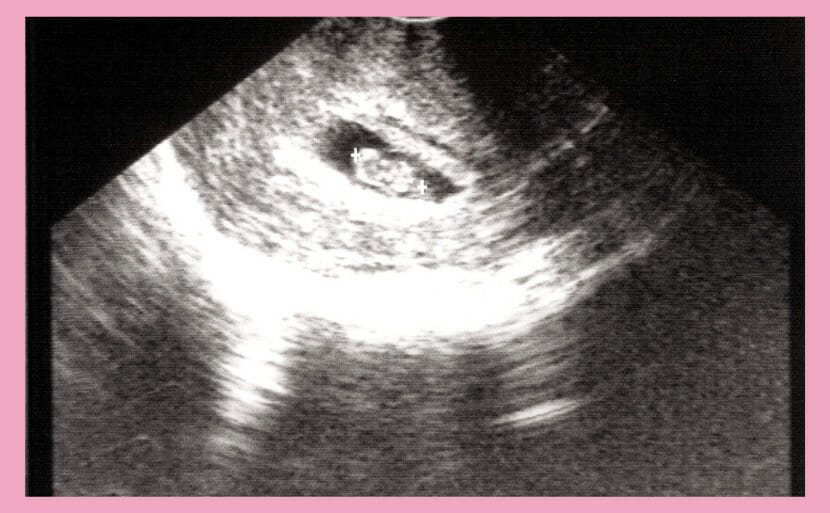 妊娠7週目の超音波 エコー写真 でダウン症は分かる 医師監修 画像あり ヒロクリニック