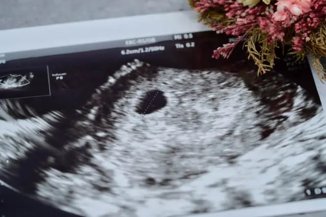 コンバインド検査とは?NIPT(新型出生前診断)との違いも紹介【医師監修】